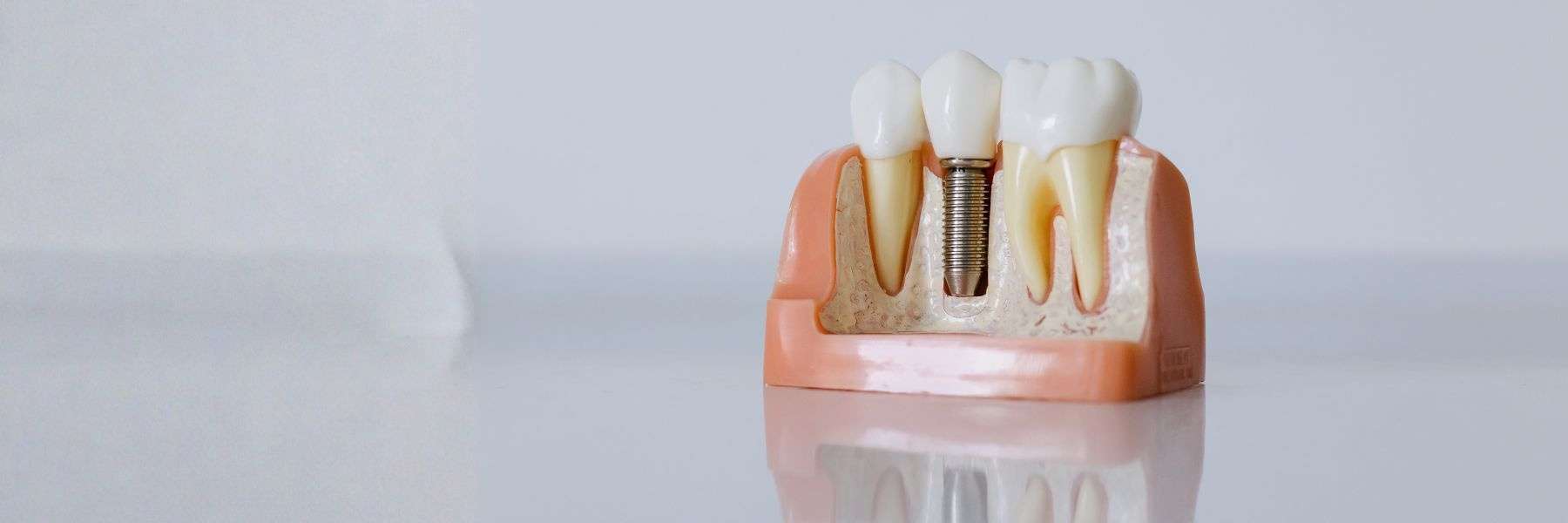 Dental Implants | Dentist